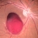 Pre retinal Hemorrhage