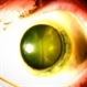 Ciliochoroidal Melanoma with Total Serous Retinal Detachment