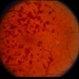 Venous Stasis Retinopathy Venous Stasis Retinopathy