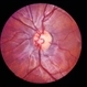 Preretinal Vascular Loop Preretinal Vascular Loop