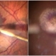 Management of Submacular Hemorrhage Management of Submacular Hemorrhage