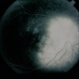 Vitreous Traction on Disc / PVD Vitreous Traction on Disc / PVD