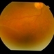 Bilateral Senile Retinoschisis