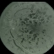 Venous Stasis Retinopathy Venous Stasis Retinopathy
