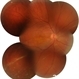 Longstanding Retinal Detachment Secondary to a Larg Retinal Tear