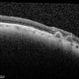 Tilted Disc Syndrome Complicated with RPE Atrophy and Polypoidal Choroidal Vasculopathy Tilted Disc Syndrome Complicated with RPE Atrophy and Polypoidal Choroidal Vasculopathy
