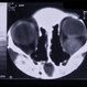 Rhabdomyosarcoma Rhabdomyosarcoma