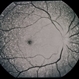 Ring 17 Chromosome Ring 17 Chromosome