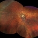 Macular dragging OS in cicatricial ROP Macular dragging OS in cicatricial ROP