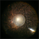 Spontaneously dropped Nucleus In a Congenital Rubella Retina disease Spontaneously dropped Nucleus In a Congenital Rubella Retina disease