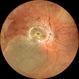 RHEGMATOGENOUS RETINAL DETACHMENT