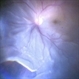 Retinal Detachment with a Large Superior Tear Retinal Detachment with a Large Superior Tear
