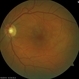 Paracentral Acute Middle Maculopathy Paracentral Acute Middle Maculopathy