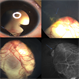 Cat Eye Syndrome Cat Eye Syndrome