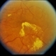 BDR / Macular Edema / Macroaneurysm BDR / Macular Edema / Macroaneurysm