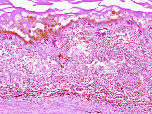 Vogt-Koyanagi-Harada Disease - Retina Image Bank