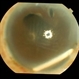 Intravitreal Implant Migration into AC