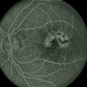 Pattern Dystrophy Pattern Dystrophy