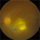 TB Granuloma