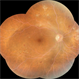 Lipemia Retinalis -Right eye Lipemia Retinalis -Right eye