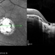 Central Areolar Choroidal Dystrophy Central Areolar Choroidal Dystrophy