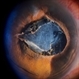 Inflammatory pupillary membrane in patient with endophthalmitis Inflammatory pupillary membrane in patient with endophthalmitis