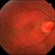 Retinal Capillary Hemangioma Retinal Capillary Hemangioma