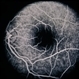Solar Retinopathy / Familial Solar Retinopathy / Familial