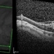 Vitreoschisis Vitreoschisis