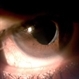 Synechiae Synechiae