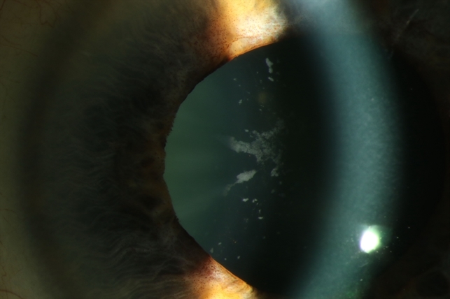 Glaukomflecken Retina Image Bank