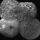Bilateral Retinal Vaso-Occlusive Disease Bilateral Retinal Vaso-Occlusive Disease