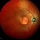 Central Areolar Choroidal Dystrophy Central Areolar Choroidal Dystrophy