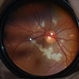 Purtcher-like retinopathy in acute pancreatitis