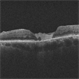 Amniotic-Membrane Grafted Macular Hole Amniotic-Membrane Grafted Macular Hole