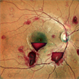 SUB HYALOID HEMORRHAGE
