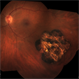 Chorioretinal Scar