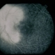 Vitreous Traction on Disc / PVD Vitreous Traction on Disc / PVD