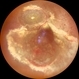 Exudative Retinal Detachment secondary to Leber's Miliary Aneurysm in a case of  Retinitis Pigmentosa