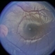 Combined Retinal / RPE Hamartoma Combined Retinal / RPE Hamartoma