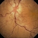 Commotio Retinae