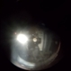 Pigmented Vitreous Cyst Pigmented Vitreous Cyst