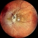 Venolymphatic Mass With Disc Edema Venolymphatic Mass With Disc Edema