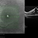 Usher's Syndrome Usher's Syndrome