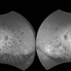 Fundus Autofluorescense Serpiginious Chorioretinitis Fundus Autofluorescense Serpiginious Chorioretinitis
