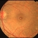Full-thickness Macular Hole Full-thickness Macular Hole