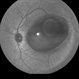 Primary Subhyaloid Hemorrhage Due to Valsalva Retinopathy