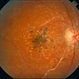 Primary Hyperoxaluria and Oxalosis
