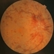 Carotid Cavernous Fistula