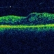 Radiation Maculopathy